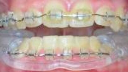 Diagnóstico y tratamiento de ATM con una nueva férula