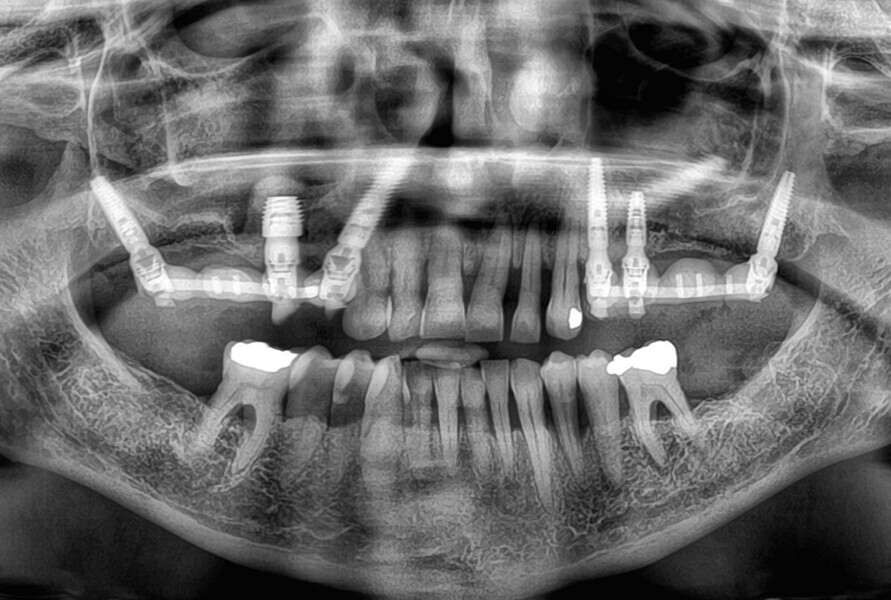 Fig. 5: Post-op radiograph. 