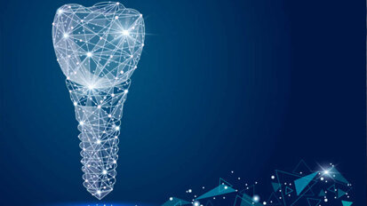 Implants individuels basés sur des procédures CAO/FAO