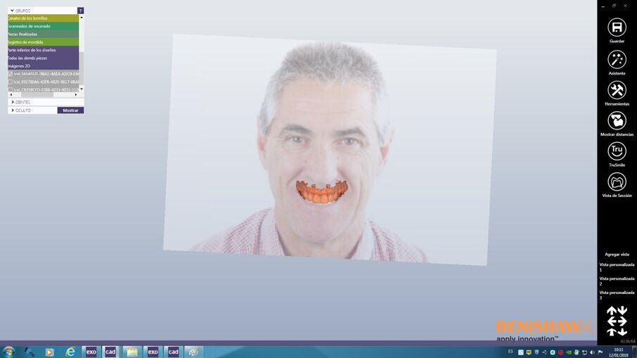 Fig. 2: Digital design of the gingiva.