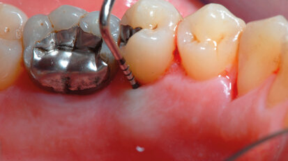 Il laser a Diodo non funziona come monoterapia. Caso clinico