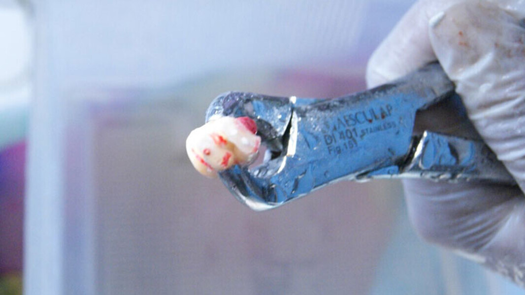 Figura 3. Diente fuera de boca tras exodoncia atraumática.