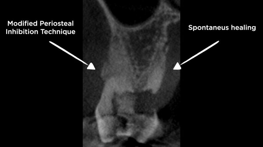 Figg. 2a, 2b - CBCT pre-estrazione