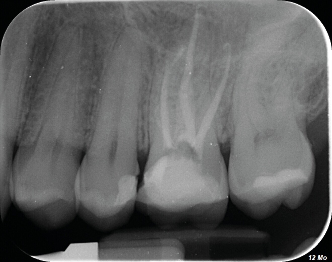 Fig. 1c : La radiographie de contrôle à un an, confirme l’efficacité du traitement par la régénération osseuse.