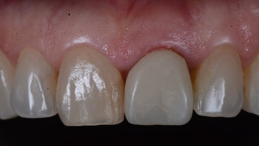 Fig. 28: Temporary crown one week post-op.