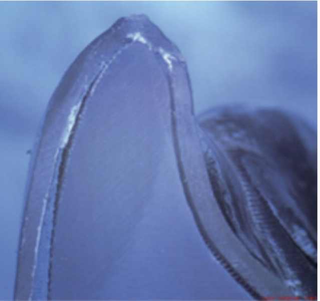 Fig. 13g: Comparison of fit between a thermoformed PETG aligner and a 3D-printed Shape Memory Aligner. The thermoformed PETG aligner shows poor fit at the incisor.