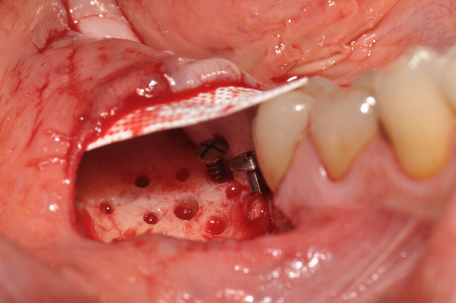 Figg. 5, 6_Si effettua la perforazione del letto osseo ricevente, il fissaggio linguale della membrana Cytoplast tireinforced ed una miscela 1:1 di osso autologo ed eterologo.