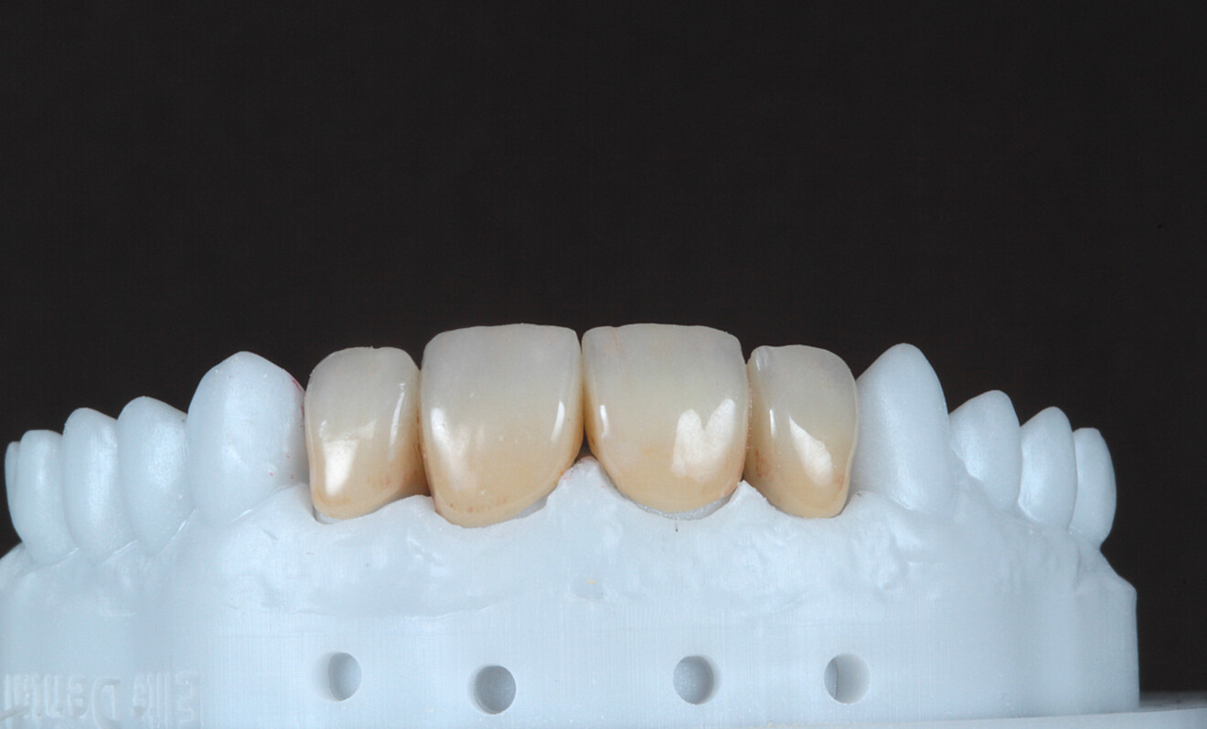 Fig. 10 : Restaurations définitives sur le modèle après finition, polissage et glaçage des surfaces.