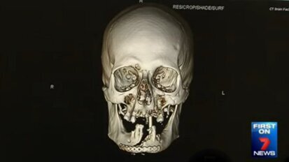 Австралийски хирурзи възстановяват лицето на мъж след инцидент с резачка за дърва