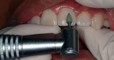 Polishing up your orthodontic finish