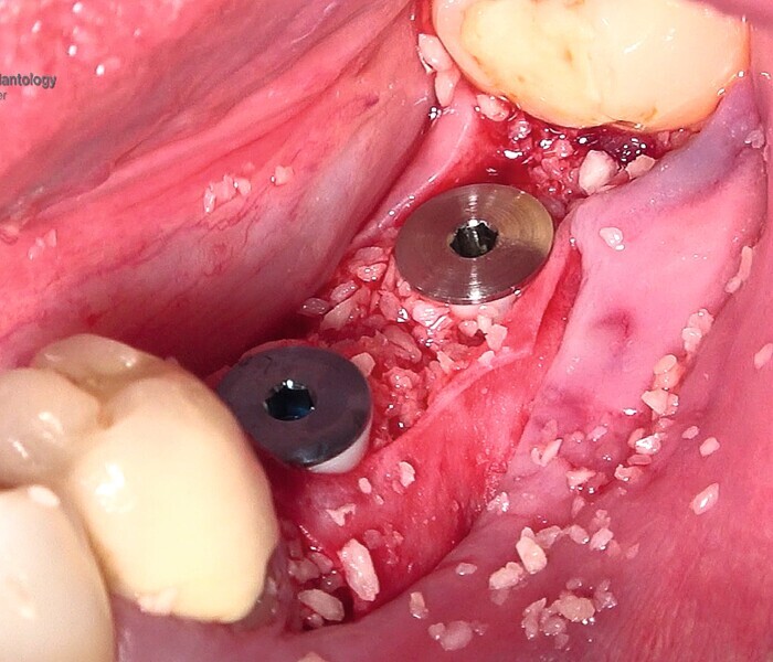 Fig. 32 : Mise en place d’une membrane de collagène à titre de barrière de protection et suture. 