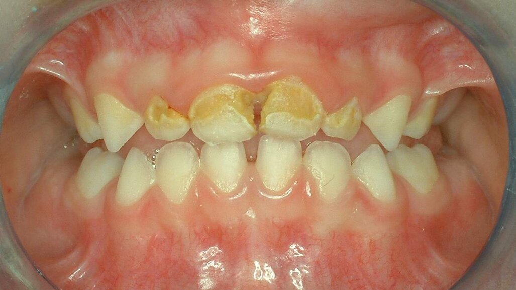 טיפול בסילבר-דיאמין-פלואוריד – לטיפול בנגעי עששת בילדים