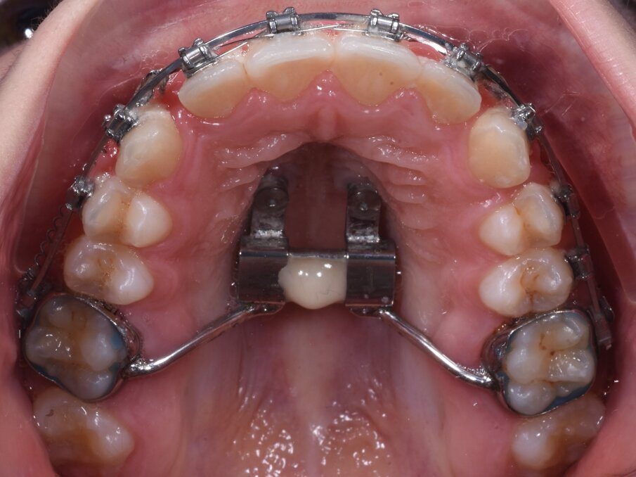 Fig. 5c_Espansore al termine delle attivazioni e finalizzazione con bracket.