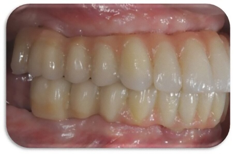 Fig. 11_Il profilo di emergenza deve essere in armonia con l’andamento della mucosa alveolare.