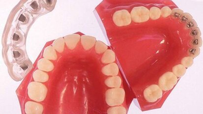 Simpli5 : la prochaine génération du traitement orthodontique invisible