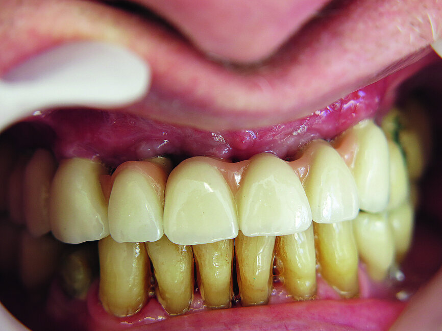 Fig. 12: Screwed on superstructure.