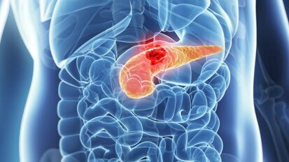 Novo teste de saliva pode detectar tumores no pâncreas