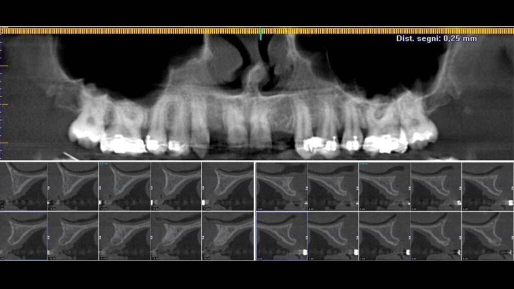 Caso di agenesia dentale trattato con impianti innovativi di diametro ridotto