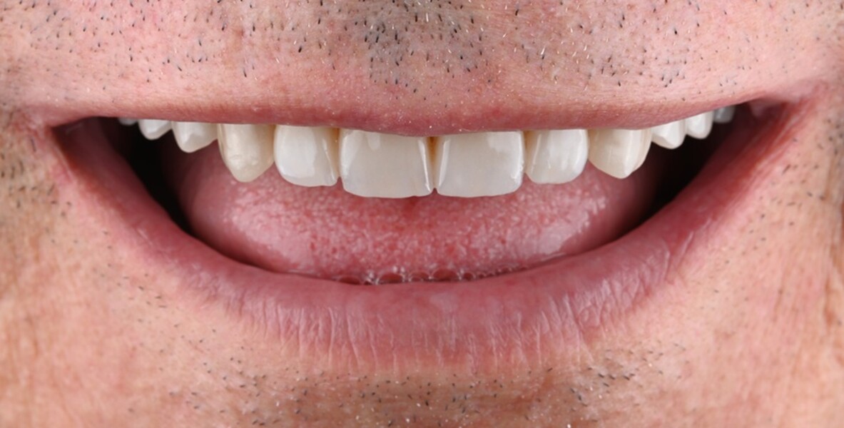 Fig. 12: Treatment outcome, extra-oral view.