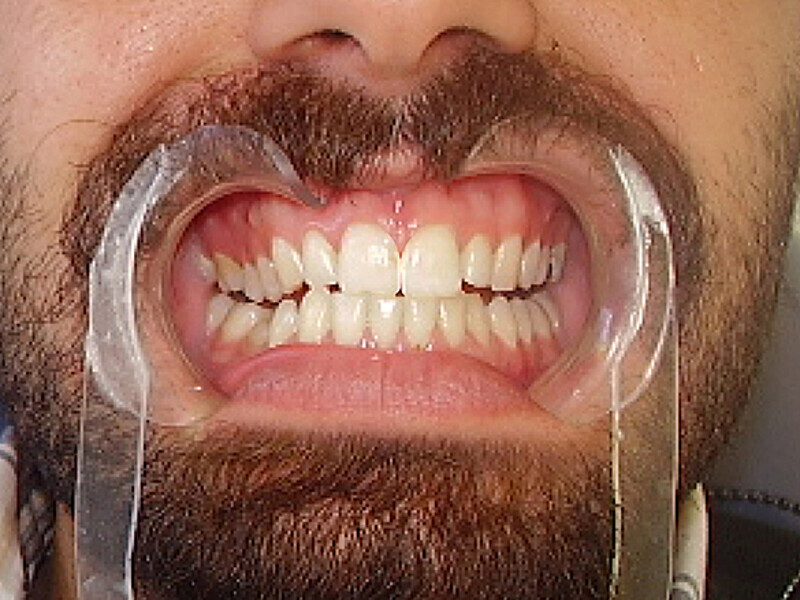 Figura 3. Cierre de diastema digital.