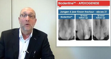 Ontdek in een korte weblezing de mogelijkheden van Biodentine