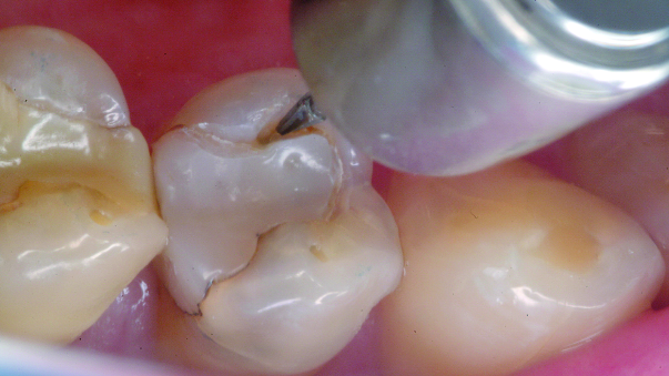 The perimeter preparation