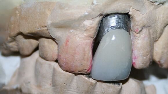 La dent d’Elvis exposée au Royaume-Uni, pour promouvoir la sensibilisation au cancer de la bouche