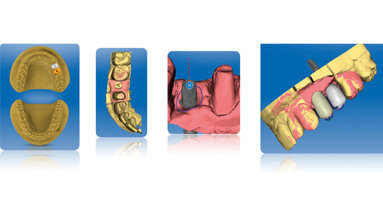 Odontoiatria digitale: gli scanner intraorali