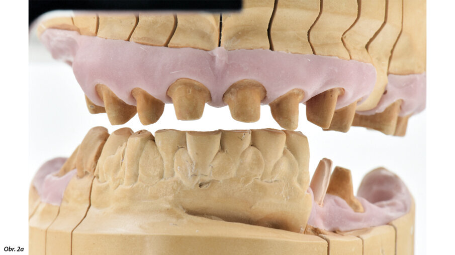 Výchozí situace se závažnou periimplantitidou.