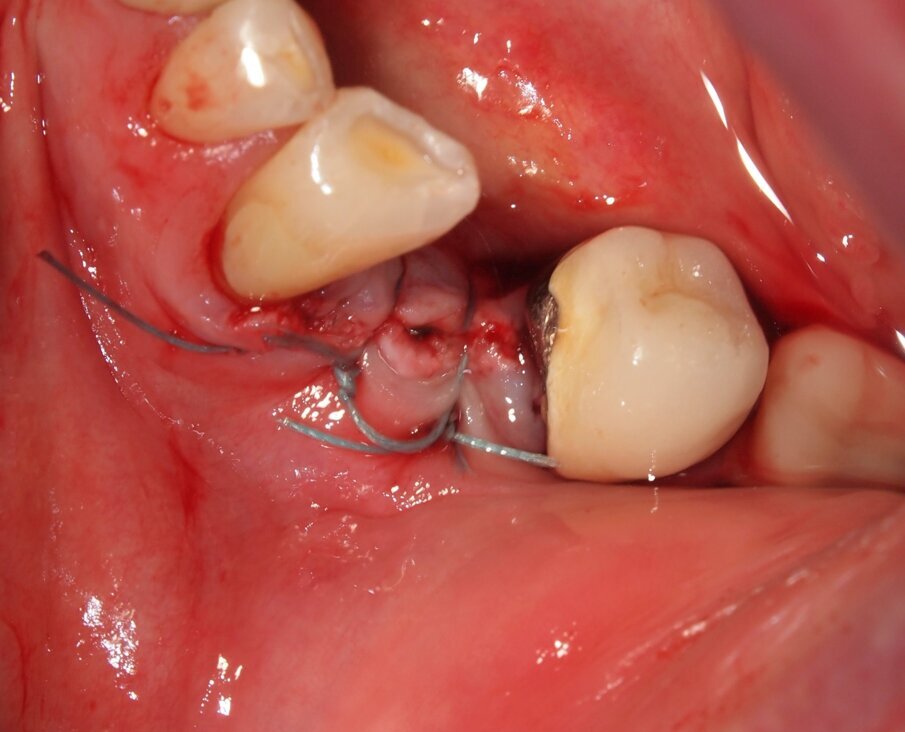 Fig. 8 - Caso clinico 1. Sutura di riposizionamento in poliammide 4/0.