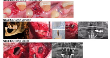 The most versatile barrier membrane for oral/maxillofacial applications