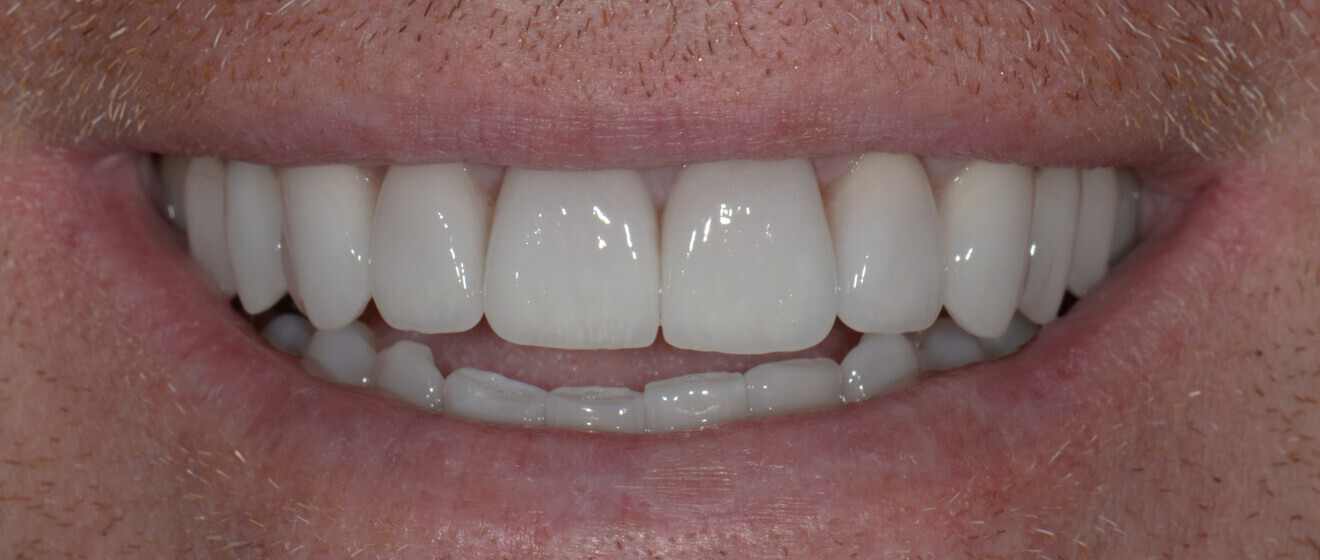 Fig. 15: New customised smile, fulfilling the patient’s expectations.