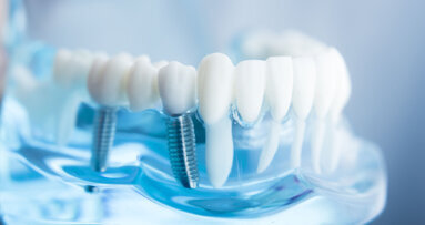 UCLA researchers develop technology to dramatically reduce peri-implantitis UCLA researchers develop technology to dramatically reduce peri-implantitis