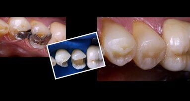 Estética Directa: luz y color en restauraciones de resina compuesta