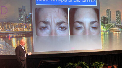 Нови ползи от ботокса