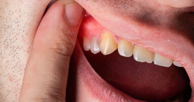 Wearable oral biosensor detects inflammation in real time