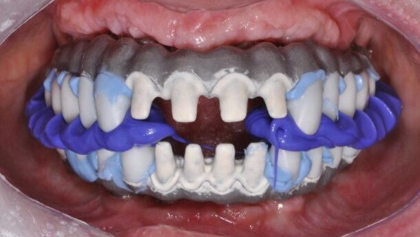 Algorytmy postępowania dla wykonywania indywidualnych rozwiązań protetycznych – cz. II: Suprastruktury przykręcane