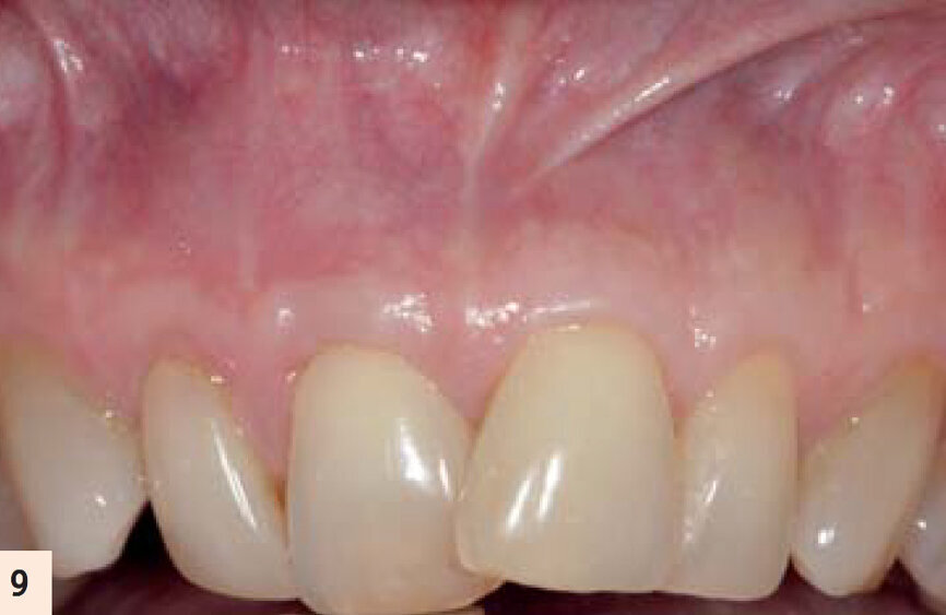 figure 9 : Deux ans postop. Noter le recouvrement radiculaire complet et l’augmentation de la zone de tissu attaché et kératinisé.