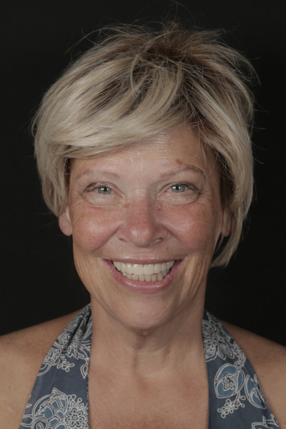 Figs. 21c: Definitive prosthesis. Intra-oral view. Full-face view.