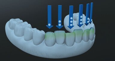 Siła Invisalign G8 – jeszcze bardziej skuteczne leczenie nakładkami