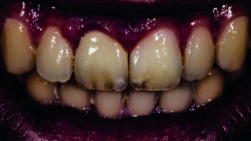 Fig. 15 : Image traitée par le programme d’édition de photo, afin de visualiser les effets internes. 