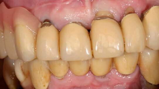 Ricostruzione completa dell’arcata mascellare edentula con il CAMLOG® Guide System