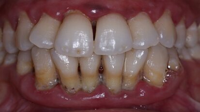 Linked: Low-level vitamin D, periodontitis and Type 2 diabetes.