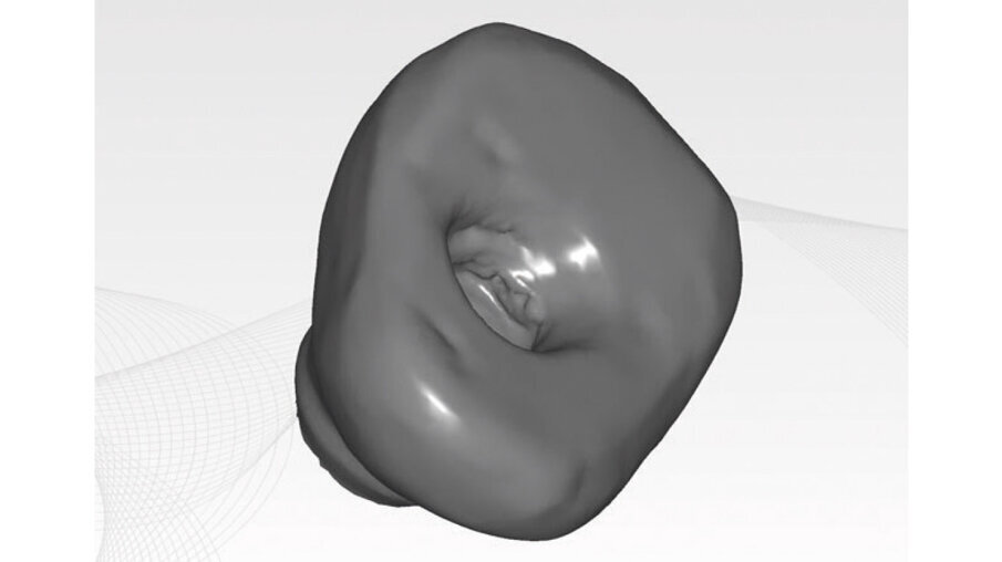 Figg. 8a-8c - Progettazione CAD della vite di guarigione customizzata.