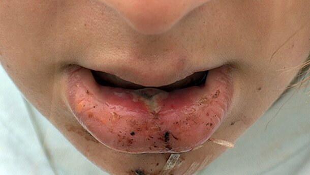 Dentists, Pharmacists Raise Awareness of Medication-Induced Dry Mouth