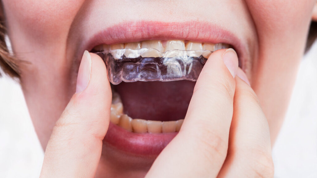 Three questions for Keith Batcheller, ClearCorrect