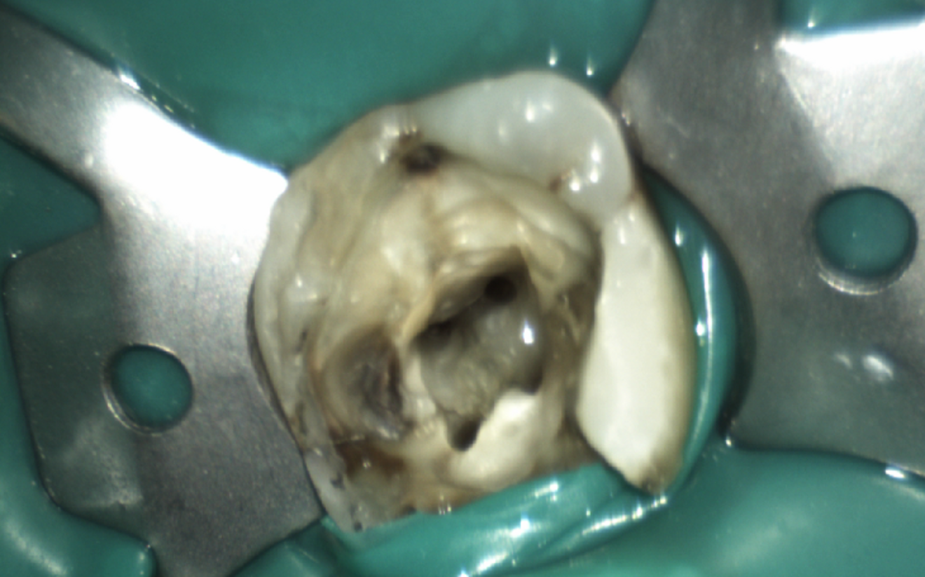 Fig. 3: Pulp chamber after irrigation with R-SWEEPS.