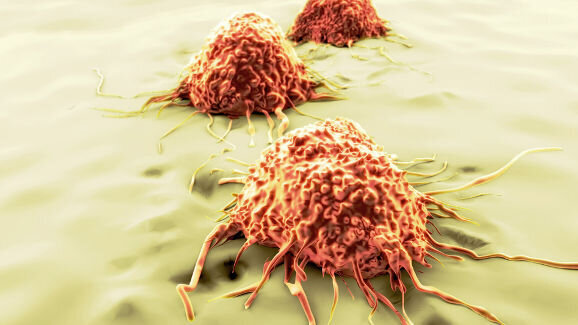 Le nombre de cellules souches cancéreuses pourrait de ne pas aider à prévoir la progression d’une tumeur et sa récurrence