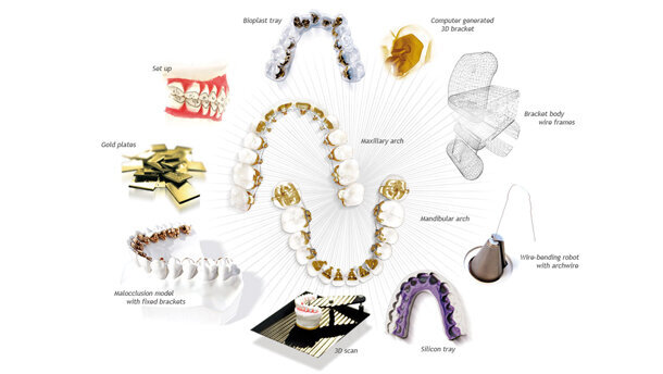 Trattamento non estrattivo di una II Classe  con incisivo centrale inferiore mancante mediante un sistema ortodontico linguale CAD/CAM