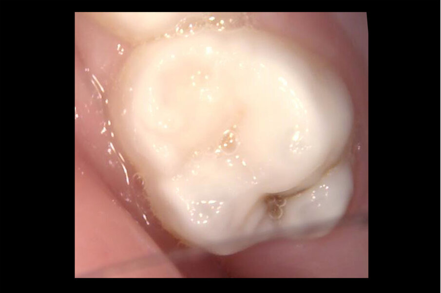 Afbeelding 7. Casus 3: 13-02-19. Intraorale foto 55 bij 3-jarig kind met zuigflescariës.
